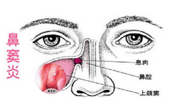 上颌窦炎的症状及原因