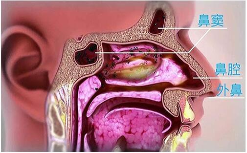 筛窦炎的病因