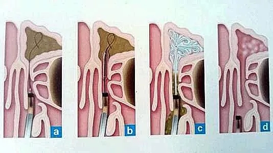 鼻窦炎治疗