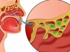 为什么有的鼻窦炎患者会流鼻血？