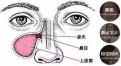 在重庆那种方法治疗鼻息肉好？