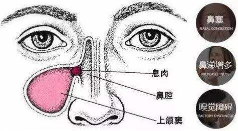 那种方法治疗鼻息肉好