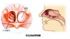 预防鼻息肉的方法有哪些