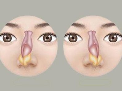 鼻中隔偏曲的症状有哪些