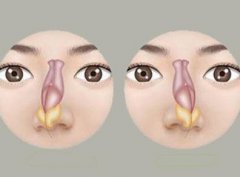 重庆好的耳鼻喉医院_鼻中隔偏曲的危害有哪些？