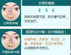 鼻中隔偏曲的常见症状表现