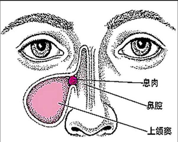 重庆看鼻息肉哪家医院好