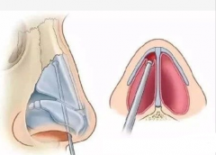 在哪些情况下鼻中隔偏曲需要手术？