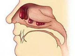 重庆鼻息肉都有哪些症状？