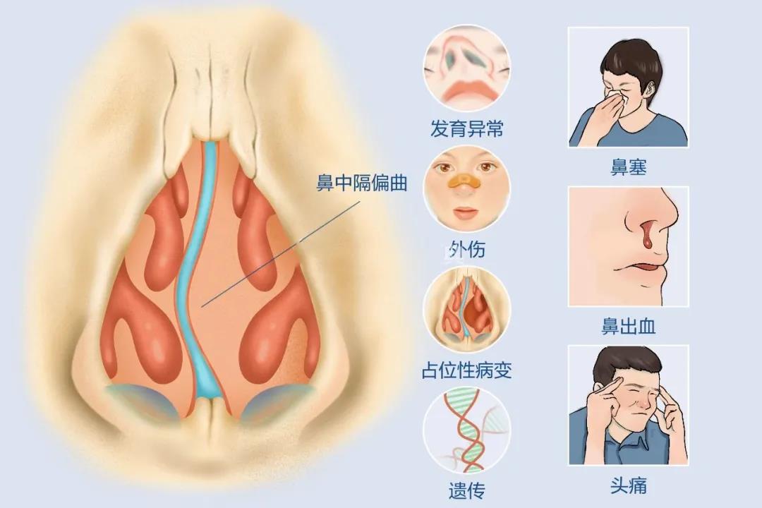 鼻中隔偏曲症状