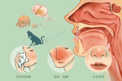 重庆看过敏性鼻炎哪家医院好？怎样才能治好过敏性鼻炎？