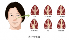 【仁品科普】鼻中隔偏曲的症状表现有哪些