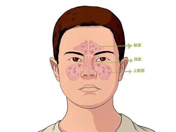 儿童鼻窦炎