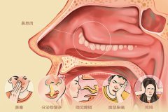 重庆鼻息肉医院，鼻息肉是不是一定要做手术