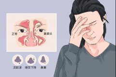 重庆鼻窦炎医院，儿童鼻窦炎的病因