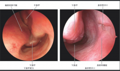 重庆治疗鼻甲肥大医院，下鼻甲肥大的病因