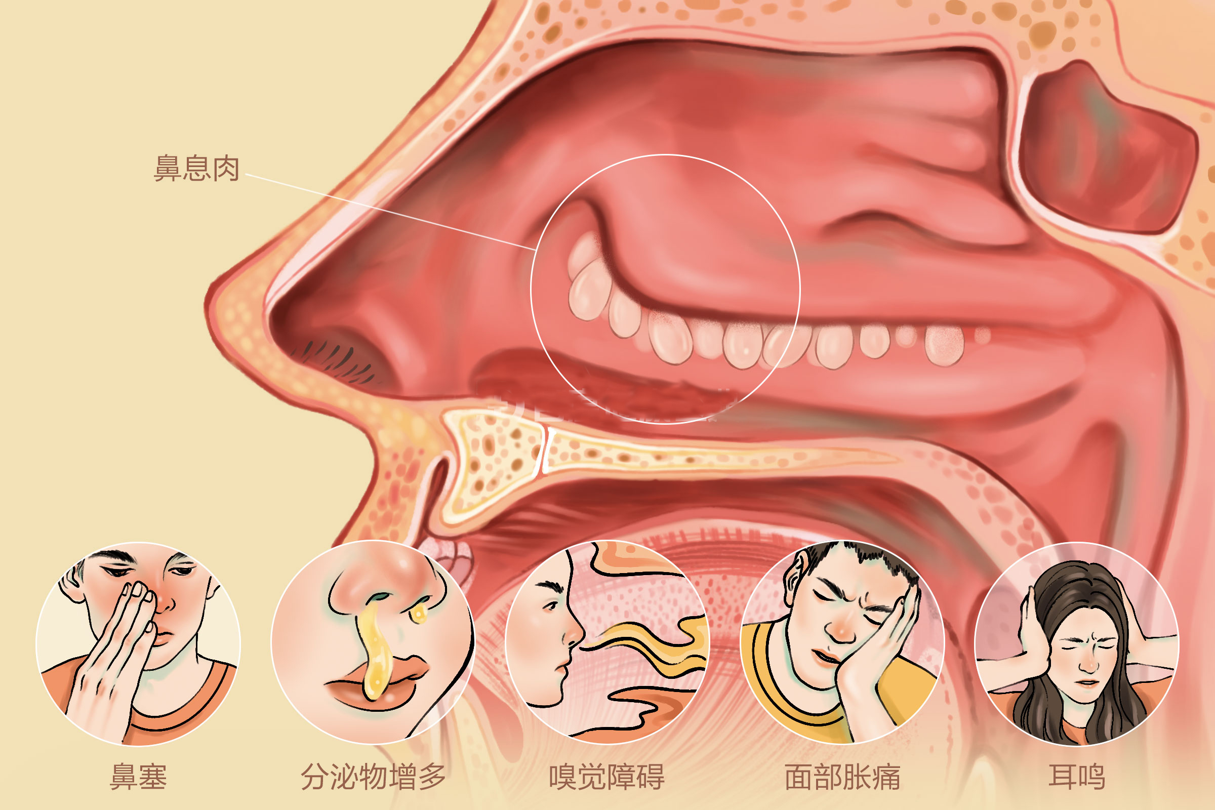 重庆鼻息肉医院