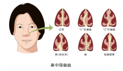 重庆鼻中隔偏曲手术哪家医院好