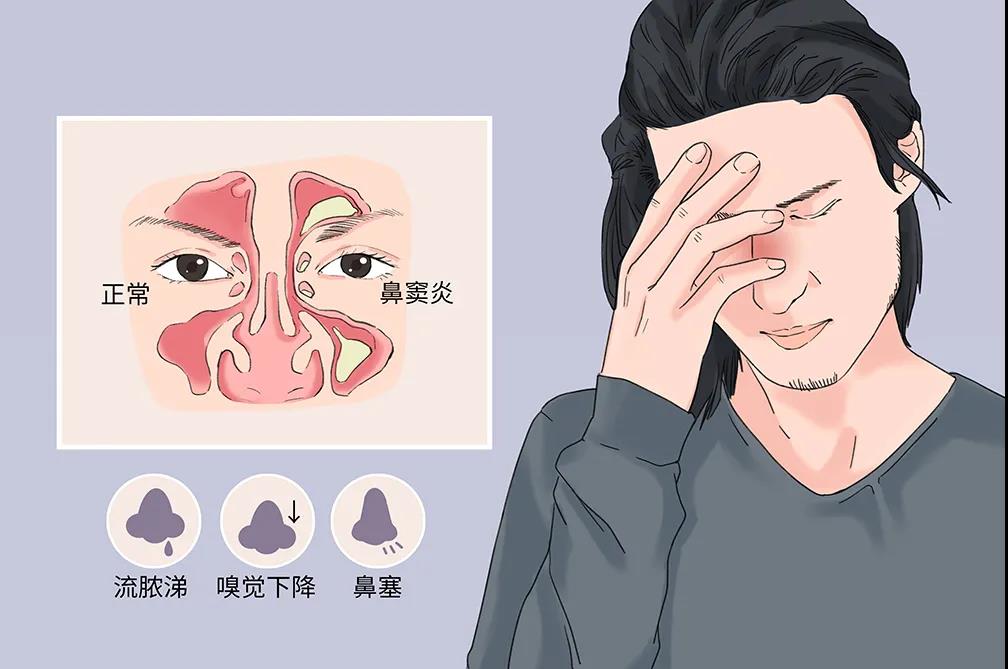 鼻窦炎的症状及表现